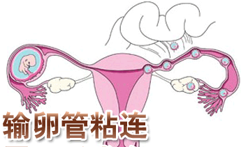 该如何有效治疗输卵管粘连,才能顺利的怀上宝宝?