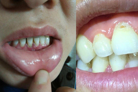 牙根为什么会外露 护理牙齿有方法