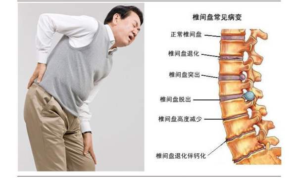 如何护理腰椎,腰间盘突出怎么办