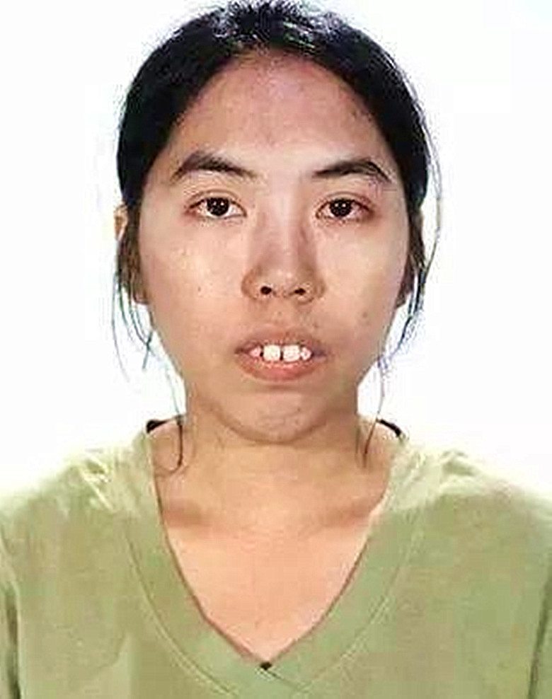 后来,lynn看到了一档整容节目,她抱着的态度参加了,很幸运的被节目组