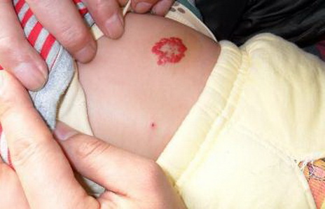 婆婆说宝宝身上长小草莓是胎记别在意,去医院检查完了后悔莫及
