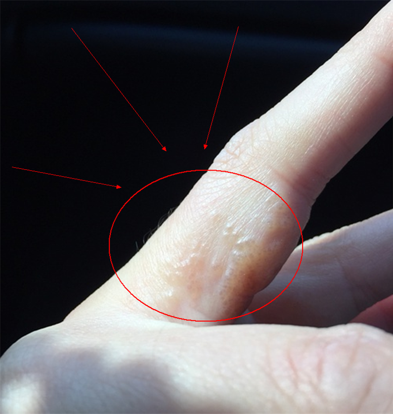 比如:手上出现密密麻麻的小水泡,指甲出现变形或者是异常形状等等