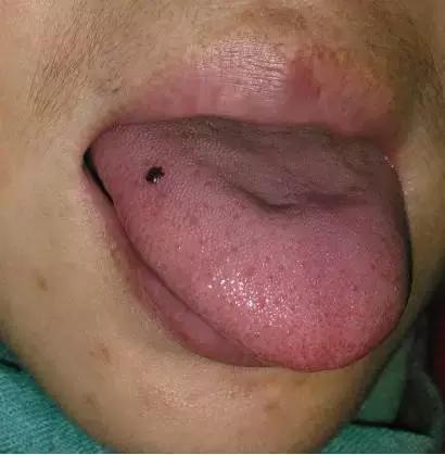 婴儿舌头上有淤血图片图片