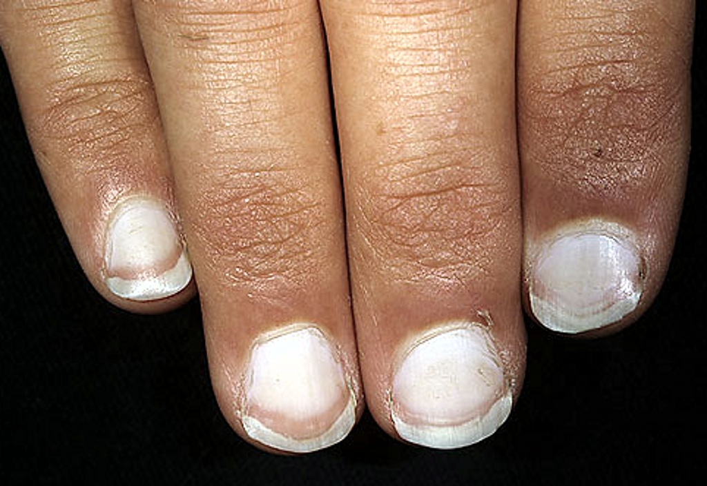 指甲竖线多 原因:正常的指甲外表是润滑的,一旦指甲上竖线相对多,而且