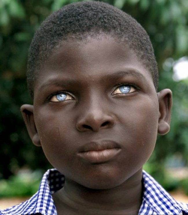 白化病的眼睛颜色图片