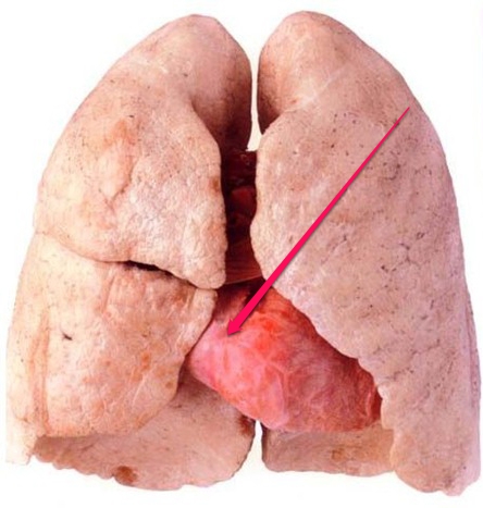 不吸烟的肺部图片图片