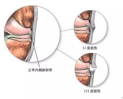 扭到膝盖