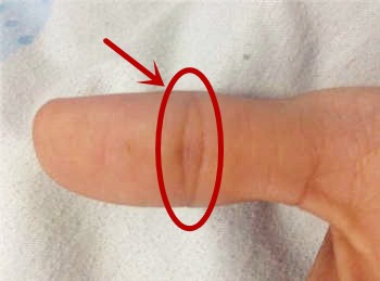 大拇指第二节网状纹图片