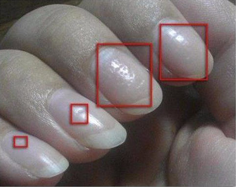 指甲竖纹多是癌症图片图片