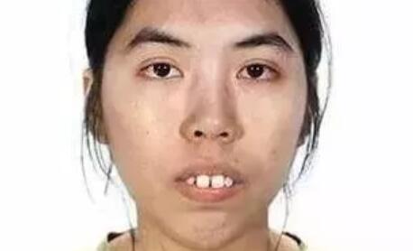 23岁泰国龅牙妹因为丑找不到工作,整容后变万人迷