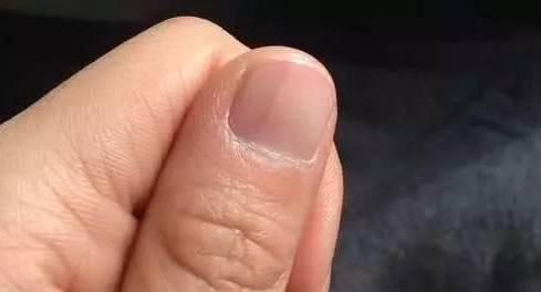 大拇指甲竖纹肝癌图片图片