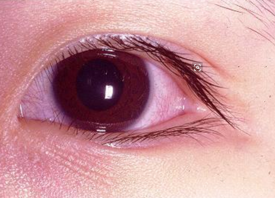 白血病眼睛是什么颜色图片