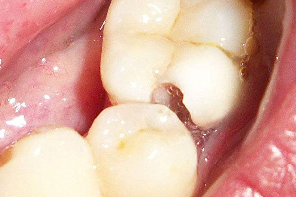 食用酸,冷食物的时候,牙齿会有种「触电」般的痛感,出现不适的症状