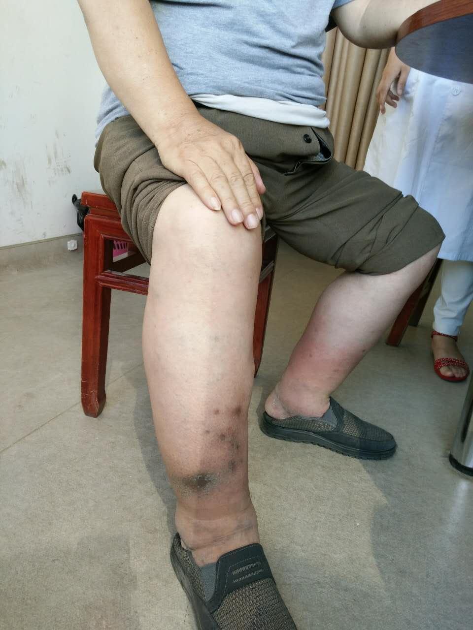 74岁老人照顾瘫痪老伴十余年,肿成大象腿却没空住院