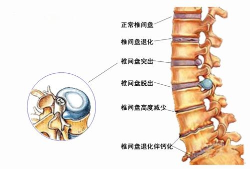 腰间盘突出不再怕