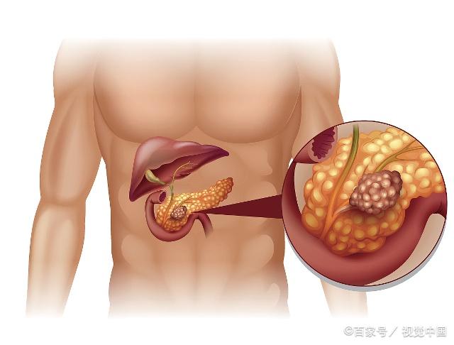 胰腺肚脐眼图片