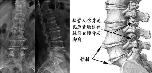 腰椎盘图片的l4l5图片