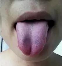 身体有了瘀血,我们从舌头上也可以看出来