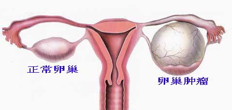 卵巢囊肿的位置图片